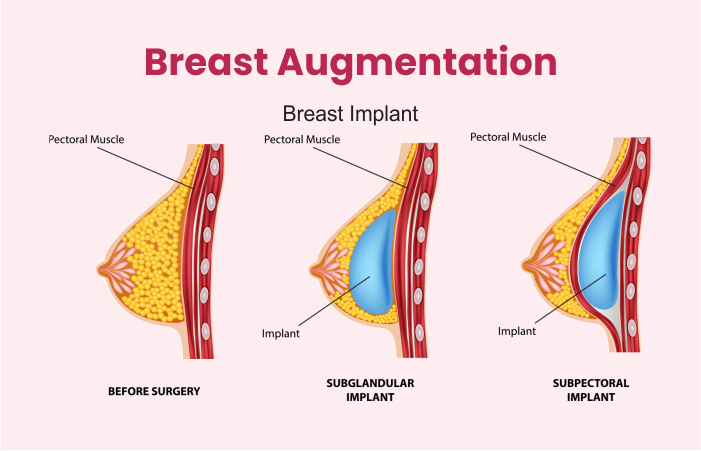 Breast Augmentation in Turkey