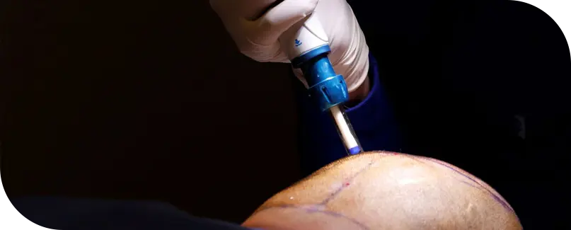 Hair Transplant Antalya Turkey