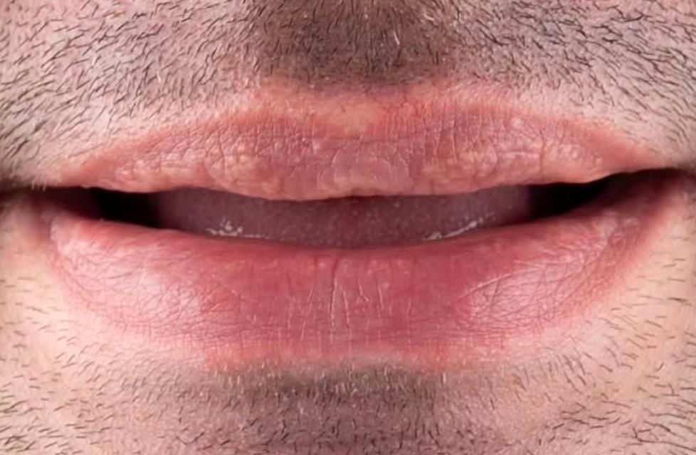 All on 4 Implant Treatment