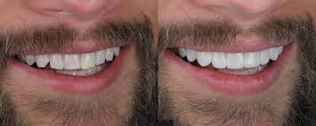 Composite Bonding Antalya