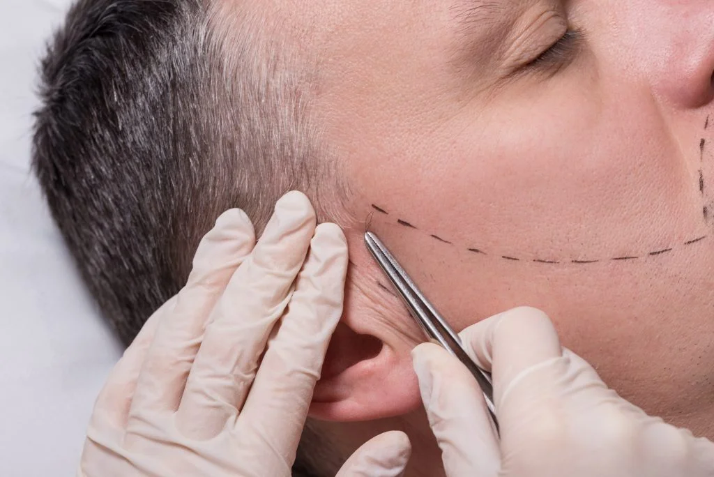 Antalya Beard Transplant