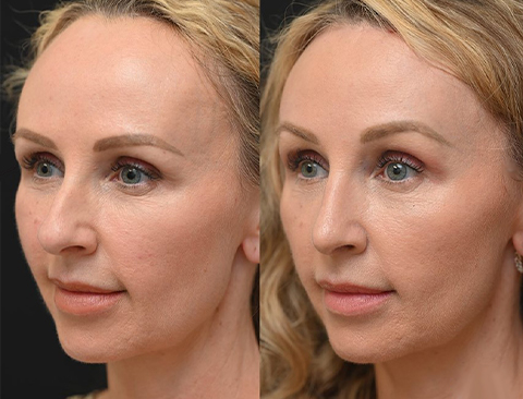 Forehead Reduction Surgery