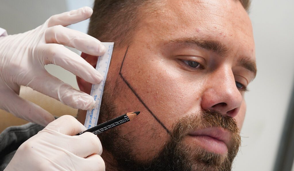 Minimal Scar Beard Transplant Techniques