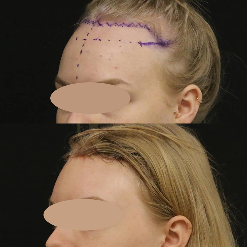 Forehead Reduction Surgery