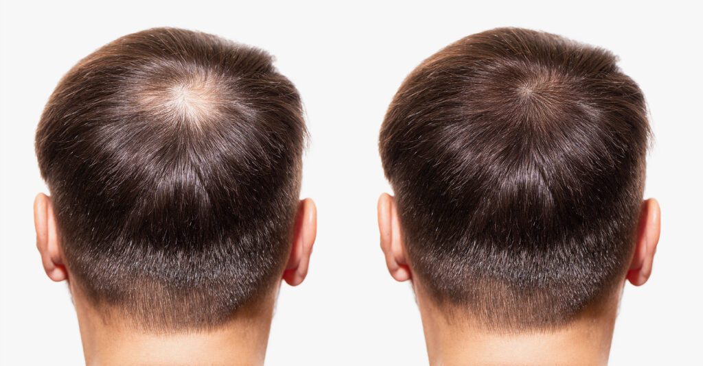 Stem Cell Hair Transplant in Alanya