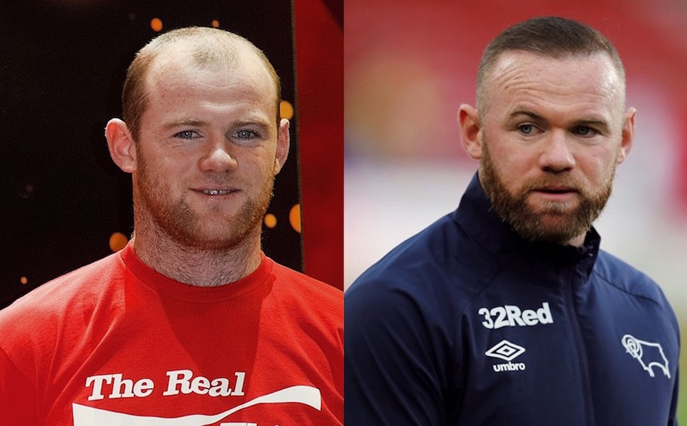Wayne Rooney Hair Transplant
