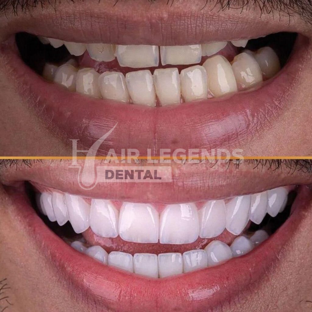 Dental Treatments for Tourists in Antalya