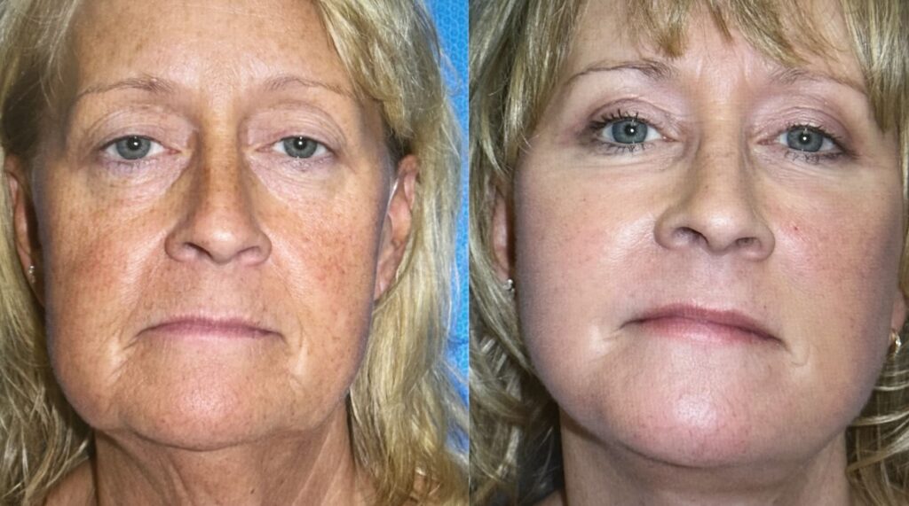 Stem Cell Therapy for Skin in Antalya