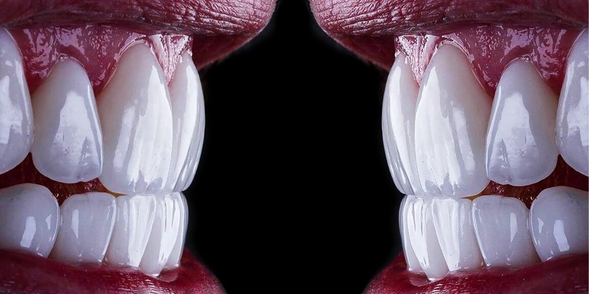 lumineers veneers antalya