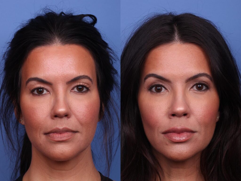 Aesthetic Surgeries in Antalya