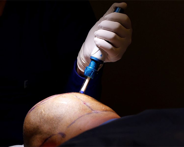 The Importance of Anesthesia in Hair Restoration