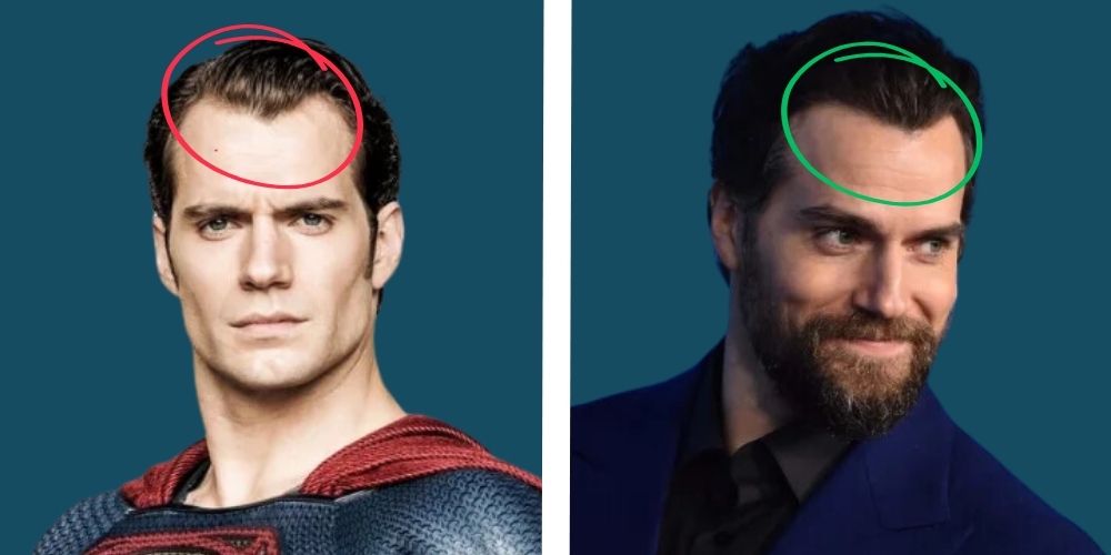 Henry Cavill Hair Transplant