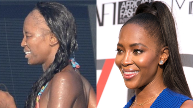 Female Celebrities Hair Transplant