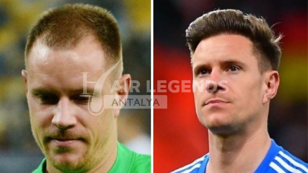 Ter Stegen Hair Transplant: Exploring the Goalkeeper's Hair Transformation