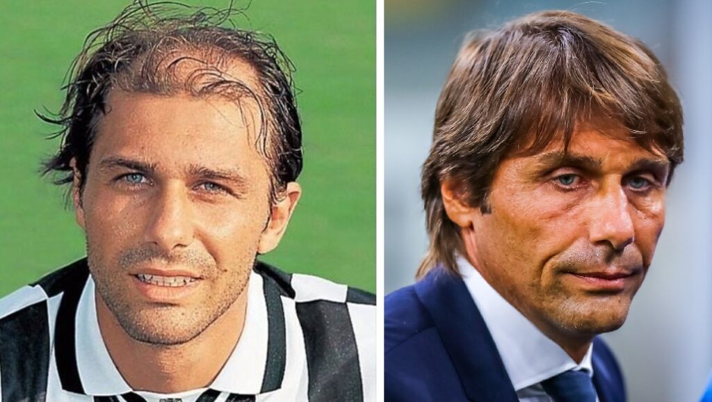 Antonio Conte Hair Transplant