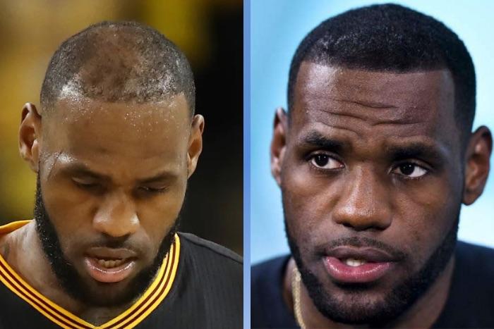 LeBron James Hair Transplant