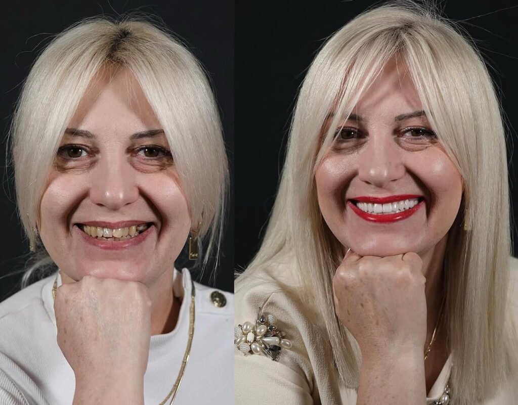 5 Implants and 24 Zirconium Crowns Antalya