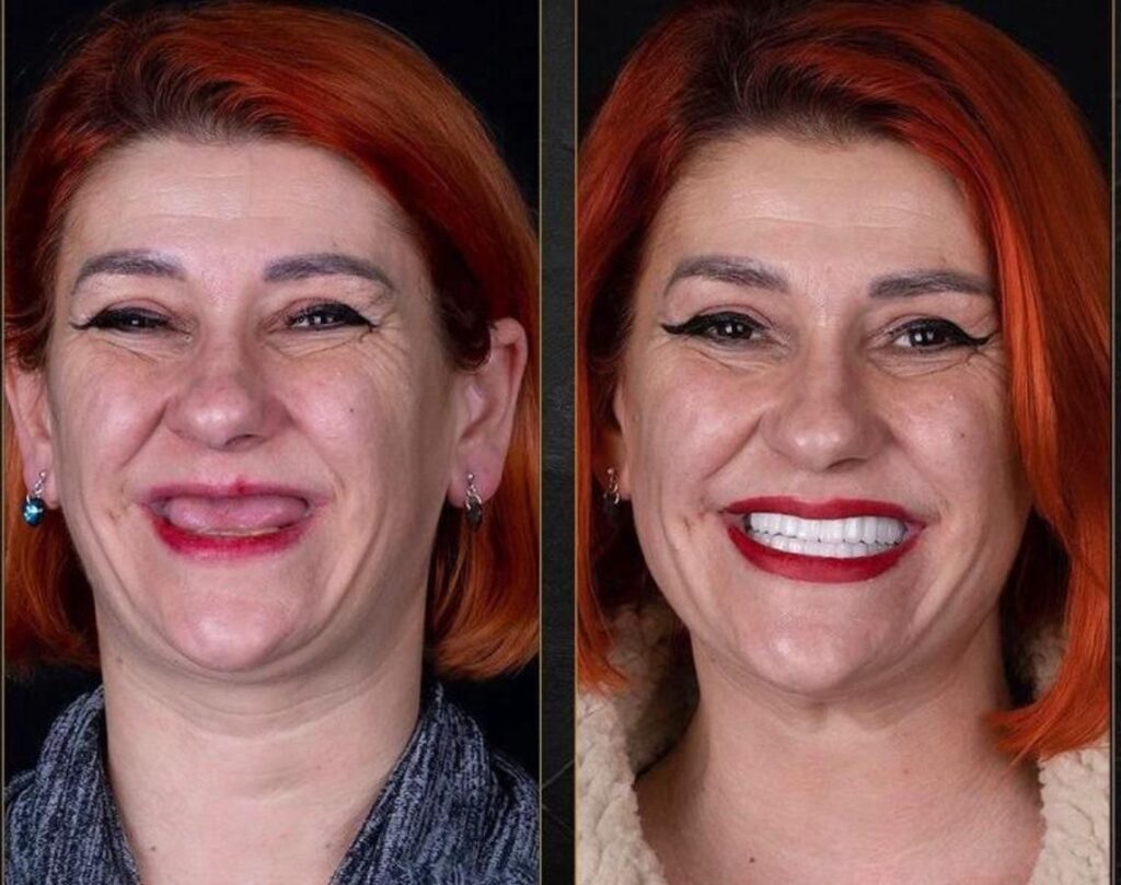 12 Implant and 24 Zirconium Crowns: A French Patient's Journey to a Perfect Smile in Antalya