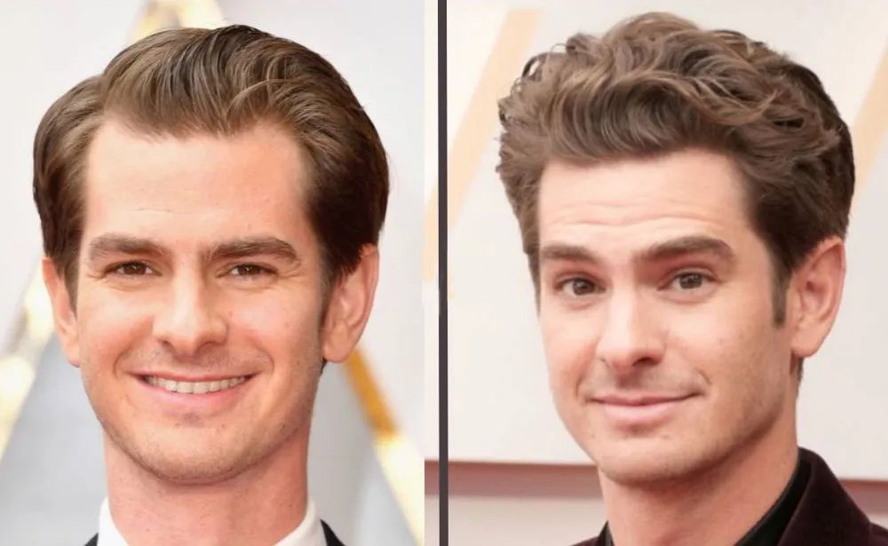 Andrew Garfield Hair Transplant