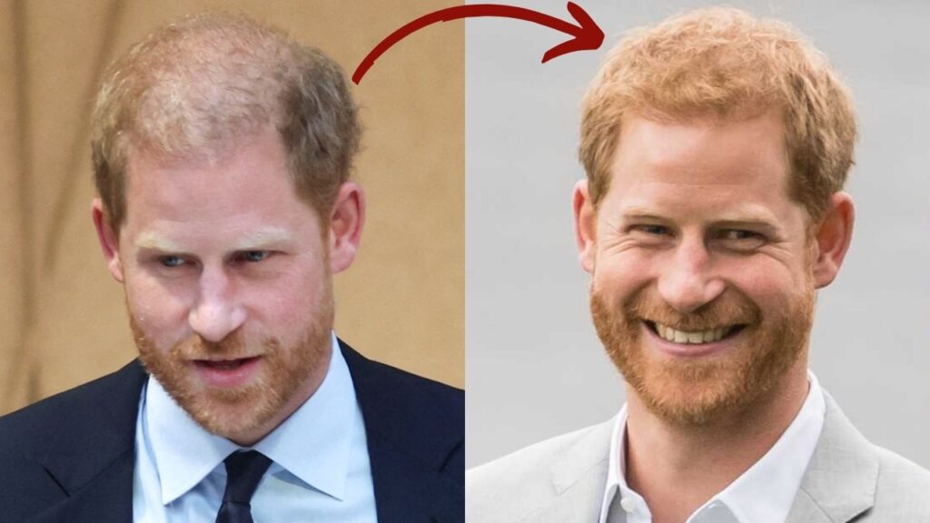 Prince Harry Hair Transplant