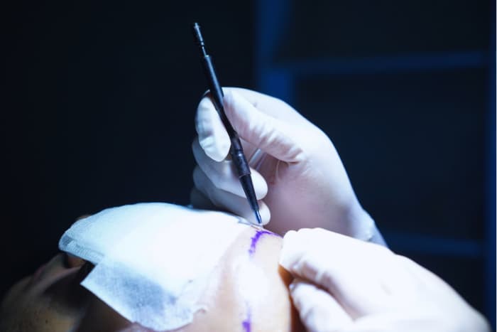 Sapphire FUE Hair Restoration