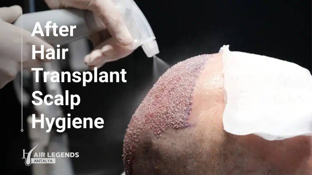 After Hair Transplant Scalp Hygiene