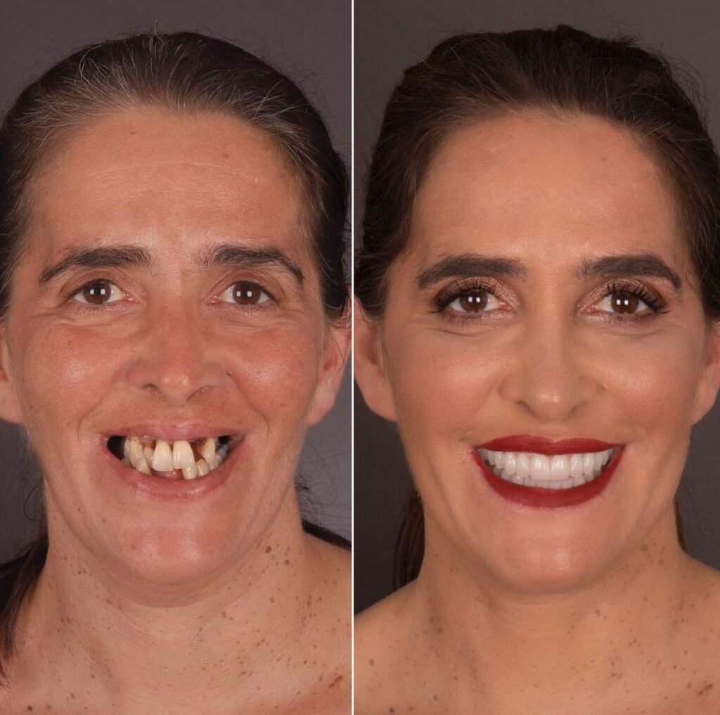 Dental Implant Antalya