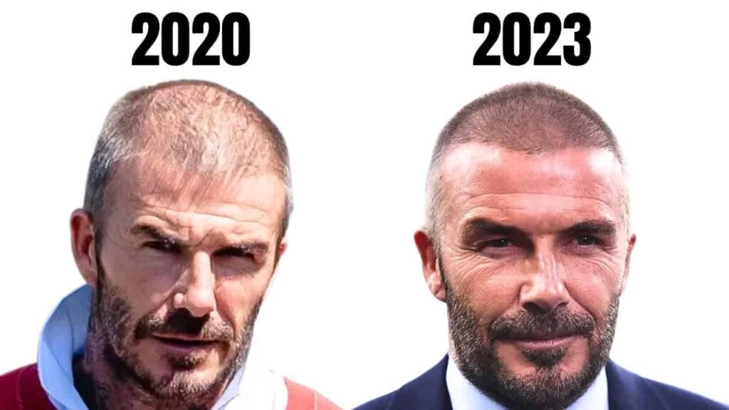 17 Footballer Hair Transplants