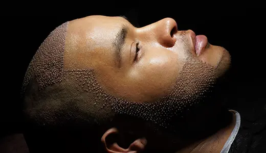 Hair Implant Cost in Antalya