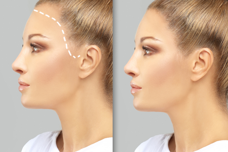 Female Hair Transplant and Restoration in Antalya