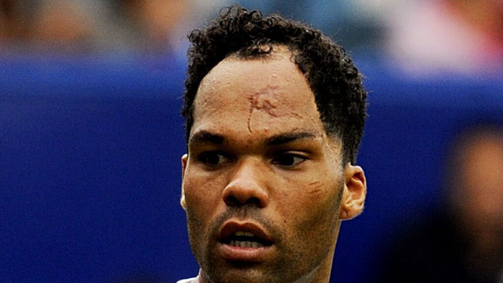 Joleon Lescott Hair Transplant