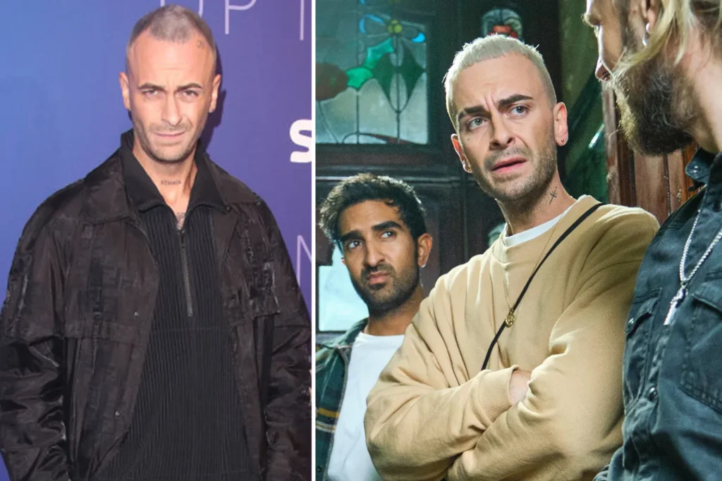 Joe Gilgun Hair Transplant