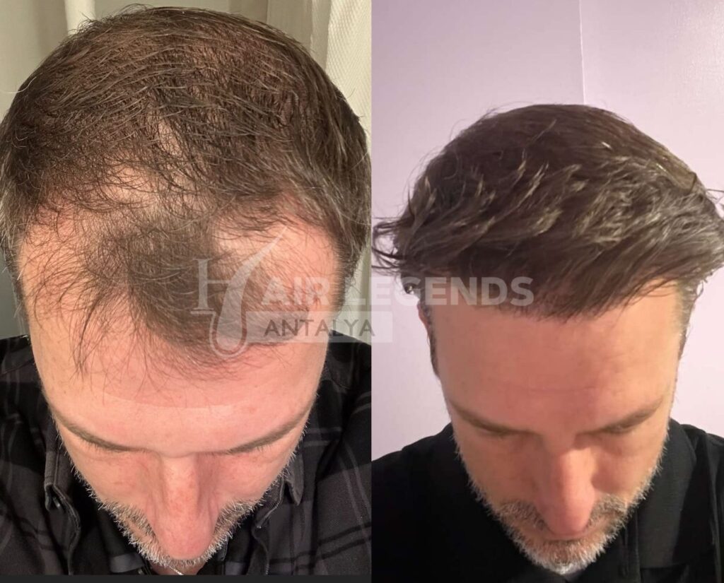 Hair Transplant Kyrenia