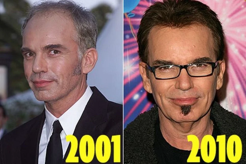 Billy Bob Thornton Hair Transplant