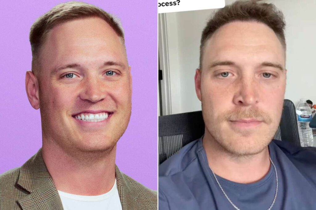 Love Is Blind Star Jimmy Hair Transplant