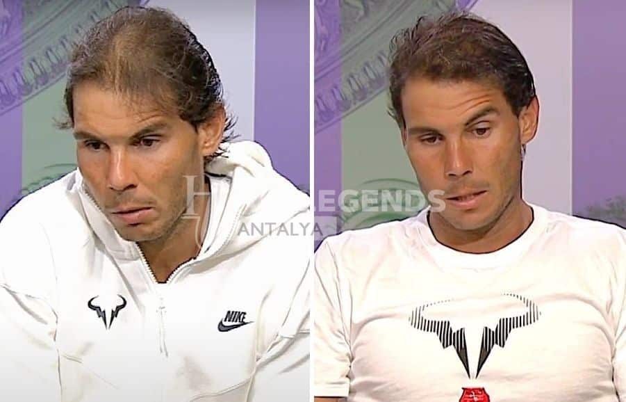 Rafael Nadal Hair Transplant