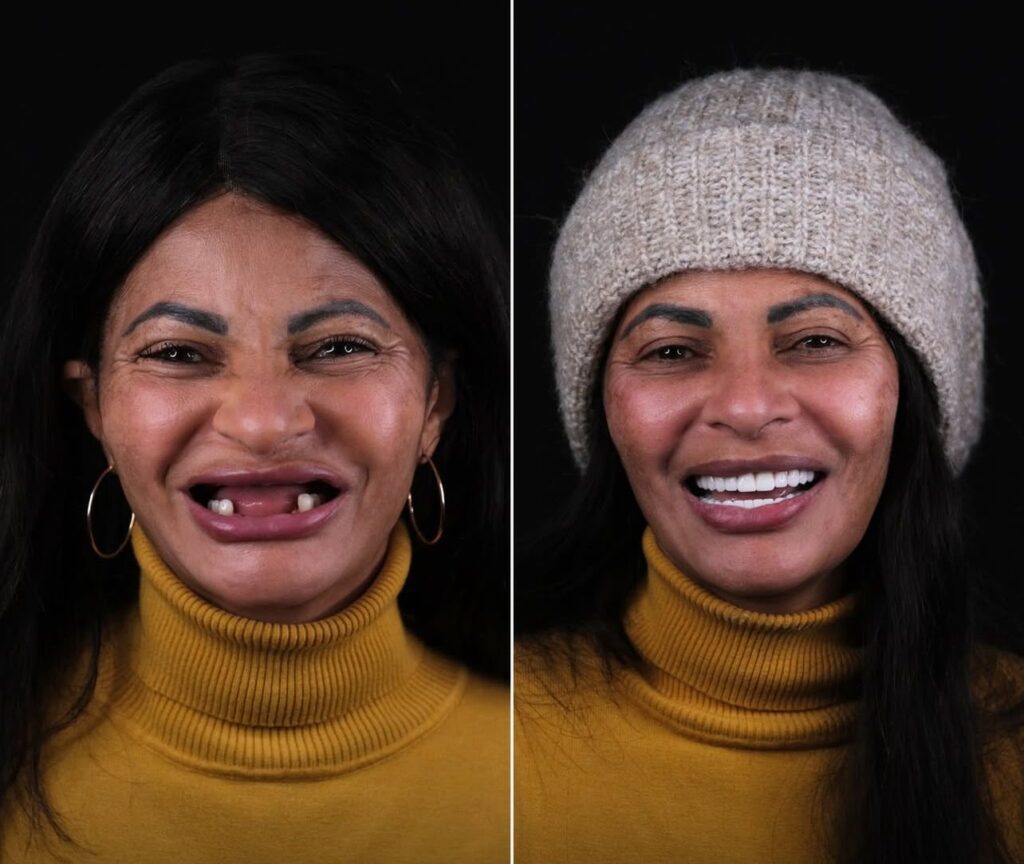 Dental Travel Packages in Antalya