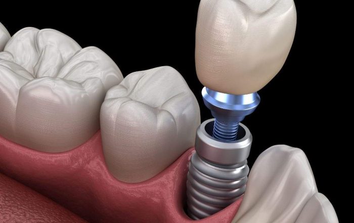 Full Mouth Dental Implants Turkey Package