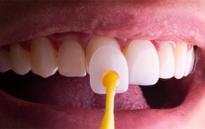 Dental Veneers Treatment