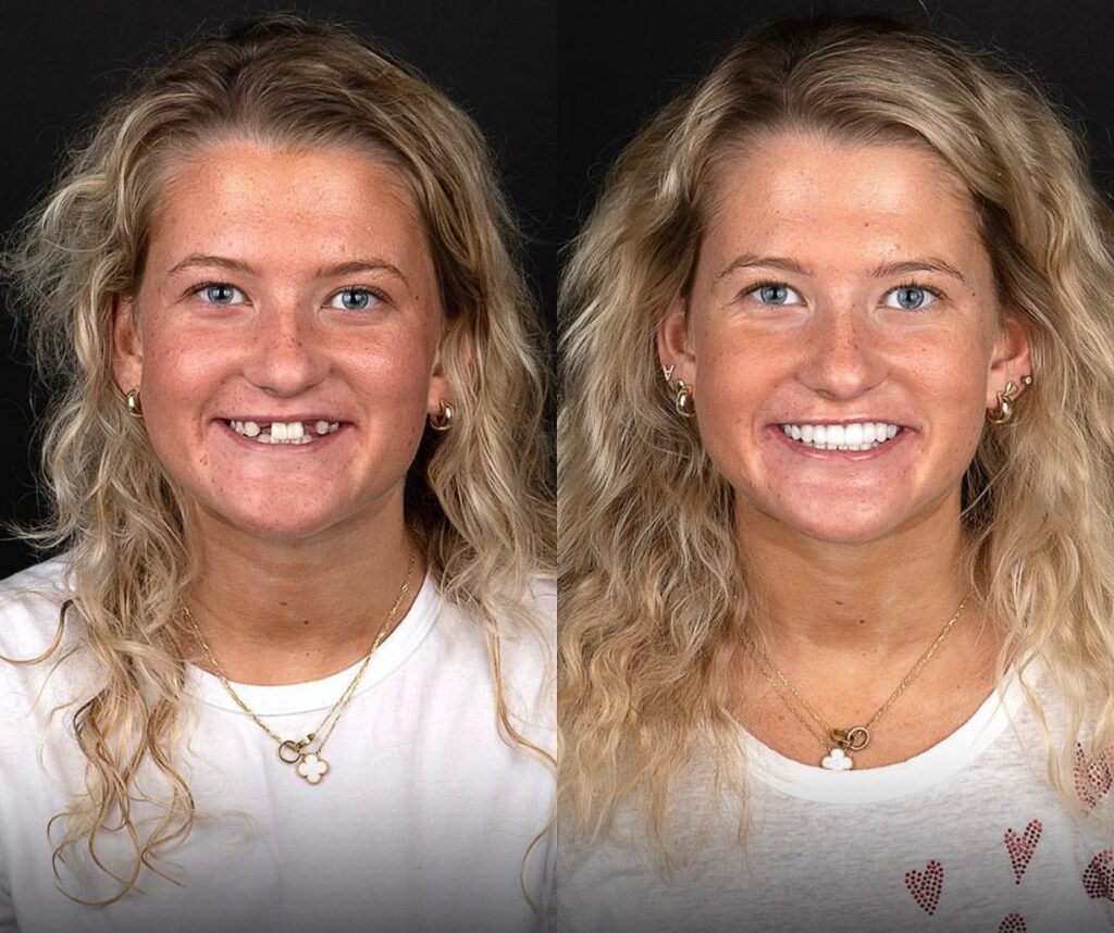 Going to Turkey for Dental Implants?