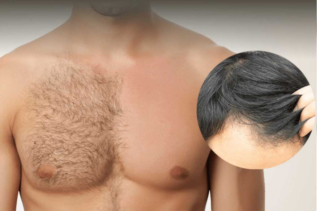 Chest Hair - Body Hair Transplant (BHT) Beard vs Scalp Grafts