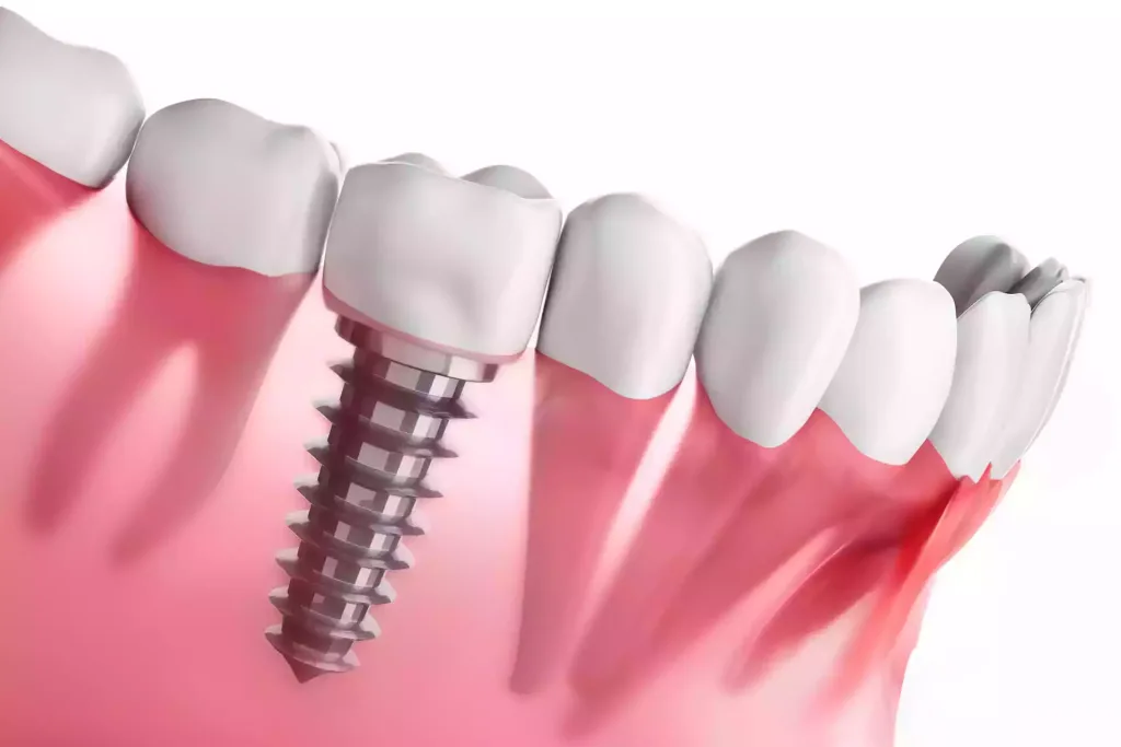 Dental Implants Price in Antalya