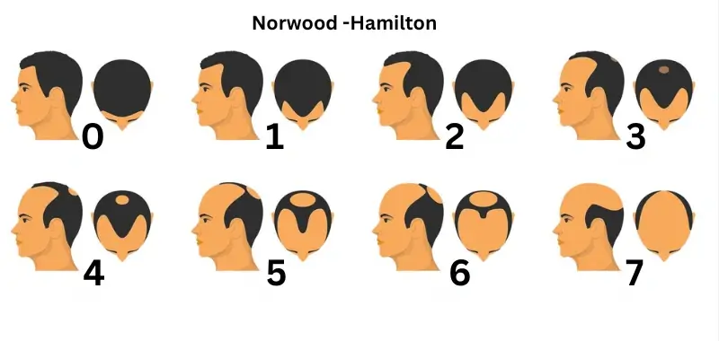 Norwood Scale