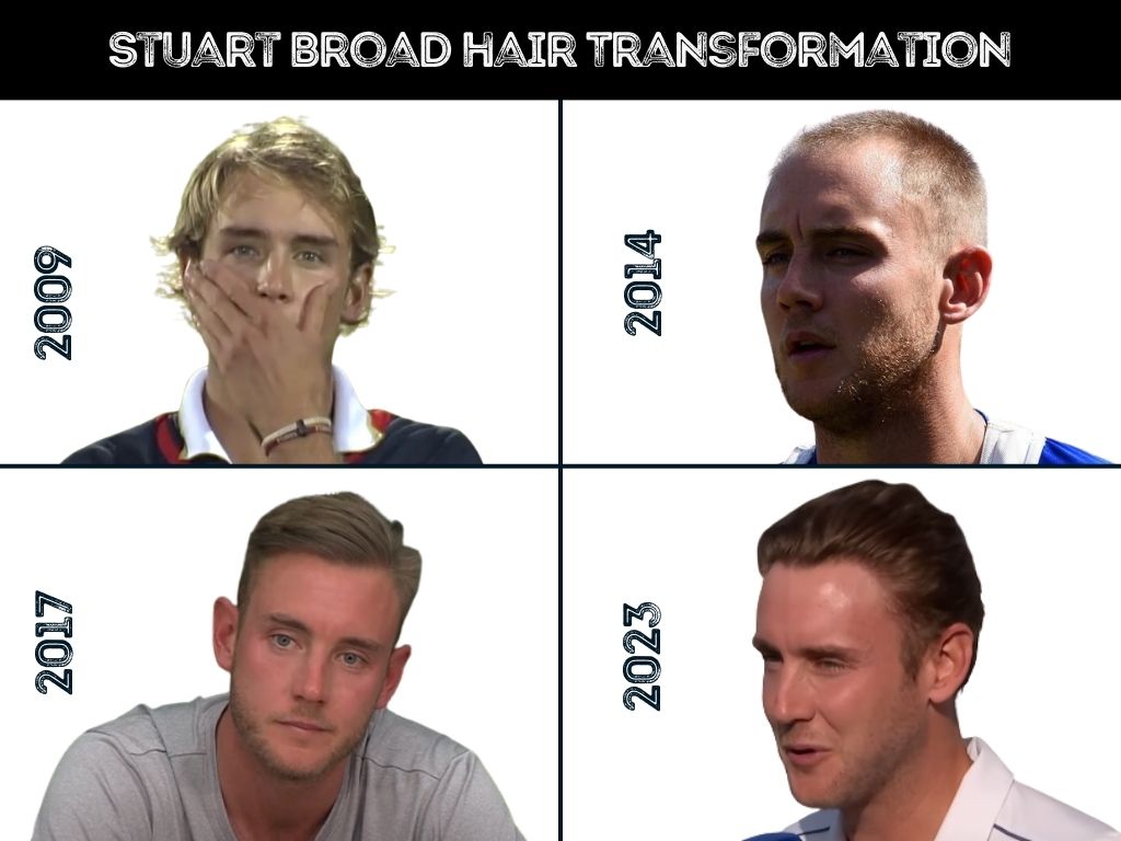 Stuart Broad Hair Transplant