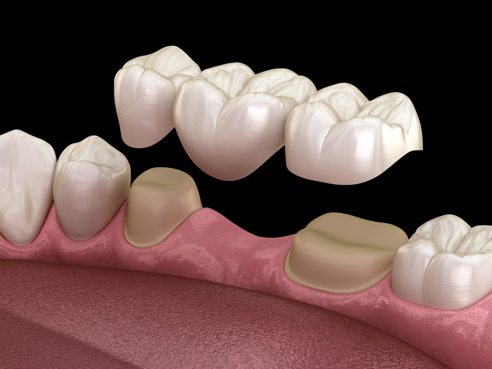 types-of-dental-bridge