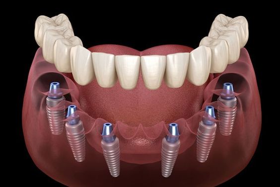 what is dental implants