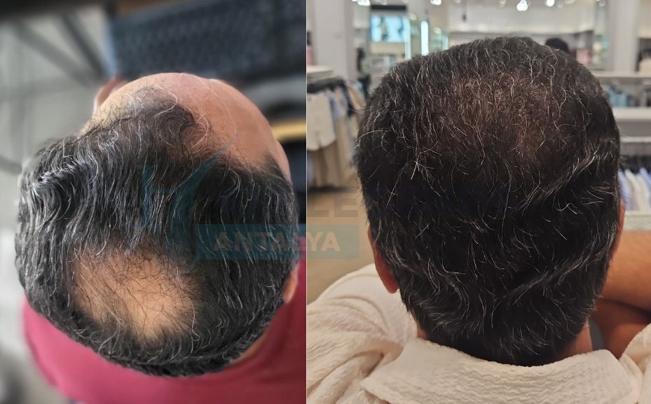 Khaled From USA: 4,500 Graft Hair Transplant Transformation
