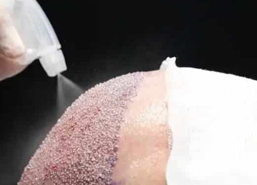 Best Hair Transplant Antalya