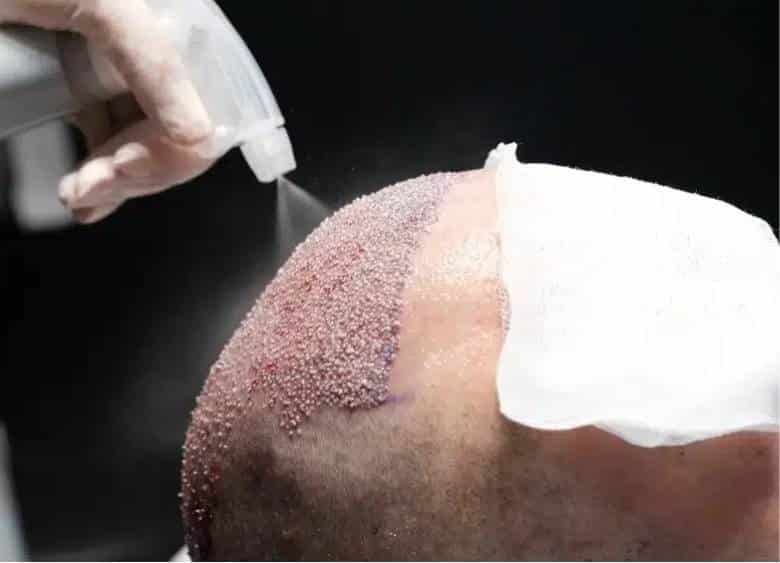 Best Hair Transplant Antalya