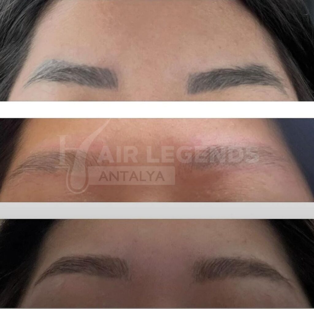 Eyebrow Transplant After Microblading